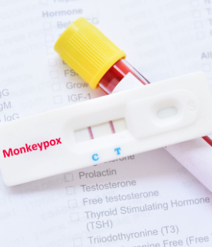 Europe Monkeypox Testing Market Size, Share, Trends, Analysis Report 2025